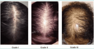 androgenic alopecia in women; receding hairline women; receding hairline in women